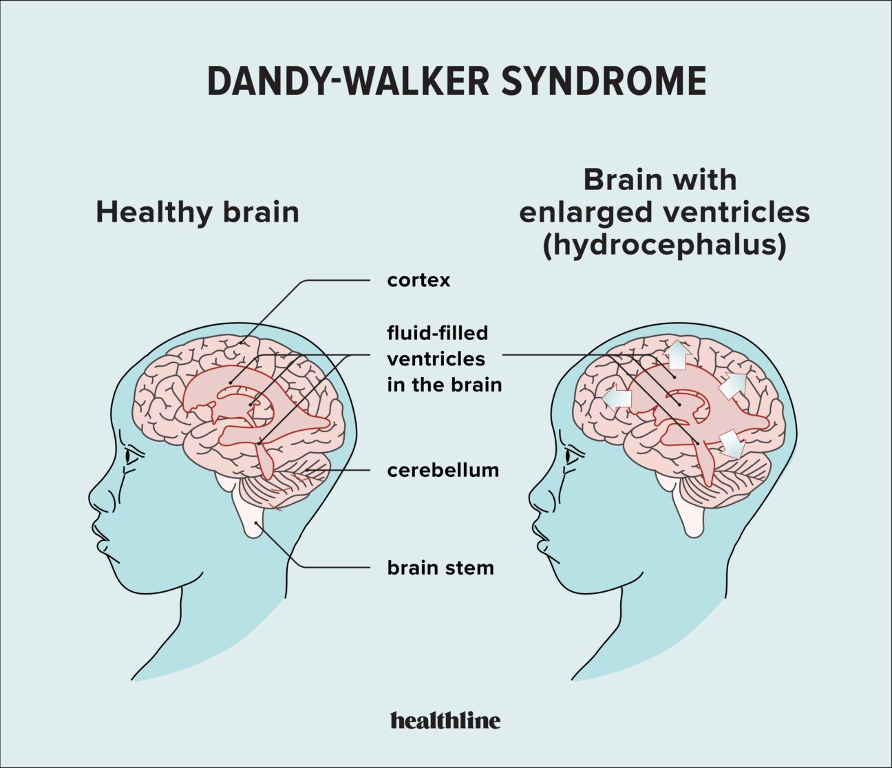 Dandy Walker Symptoms: What to Watch and Understand