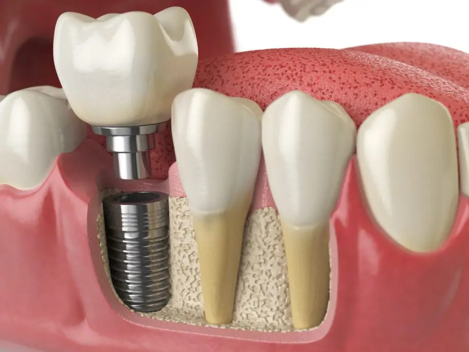 Dental Implant Surgery: Essential Guide for You