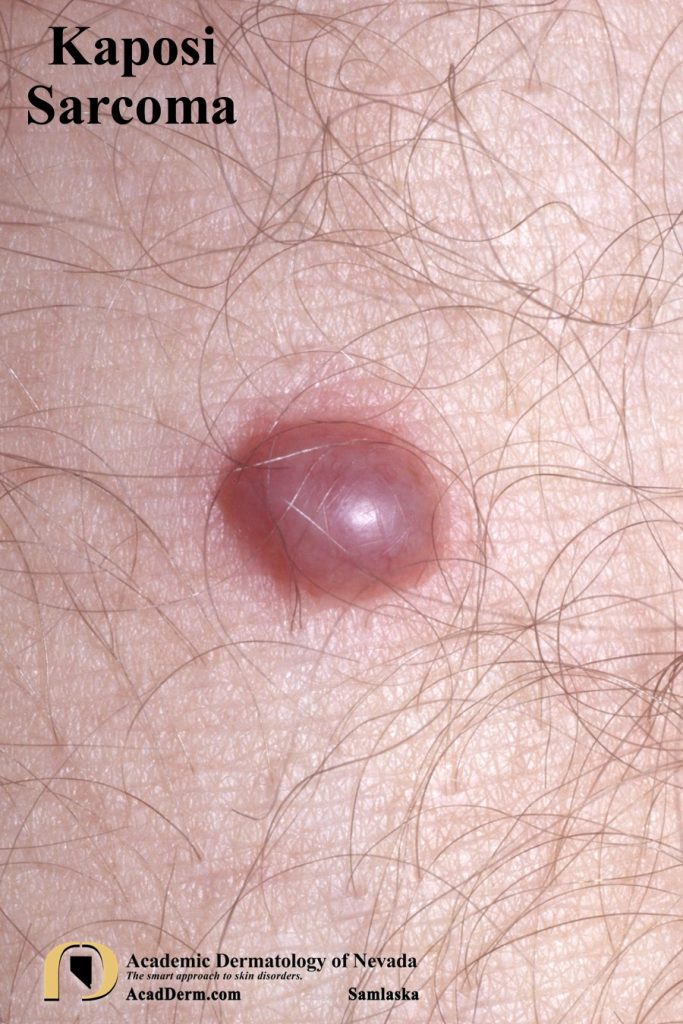 Early Kaposi Sarcoma: What You Need to Know Now