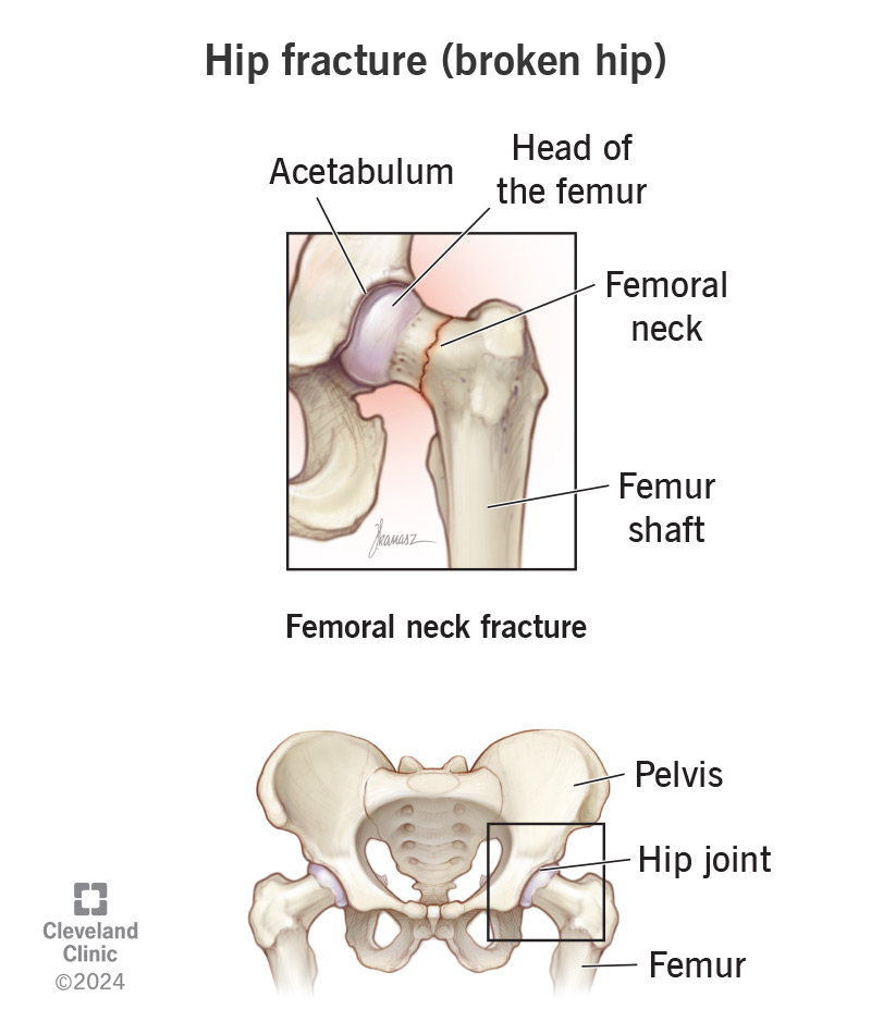 Hip fracture causes – What truly puts your hip at risk?