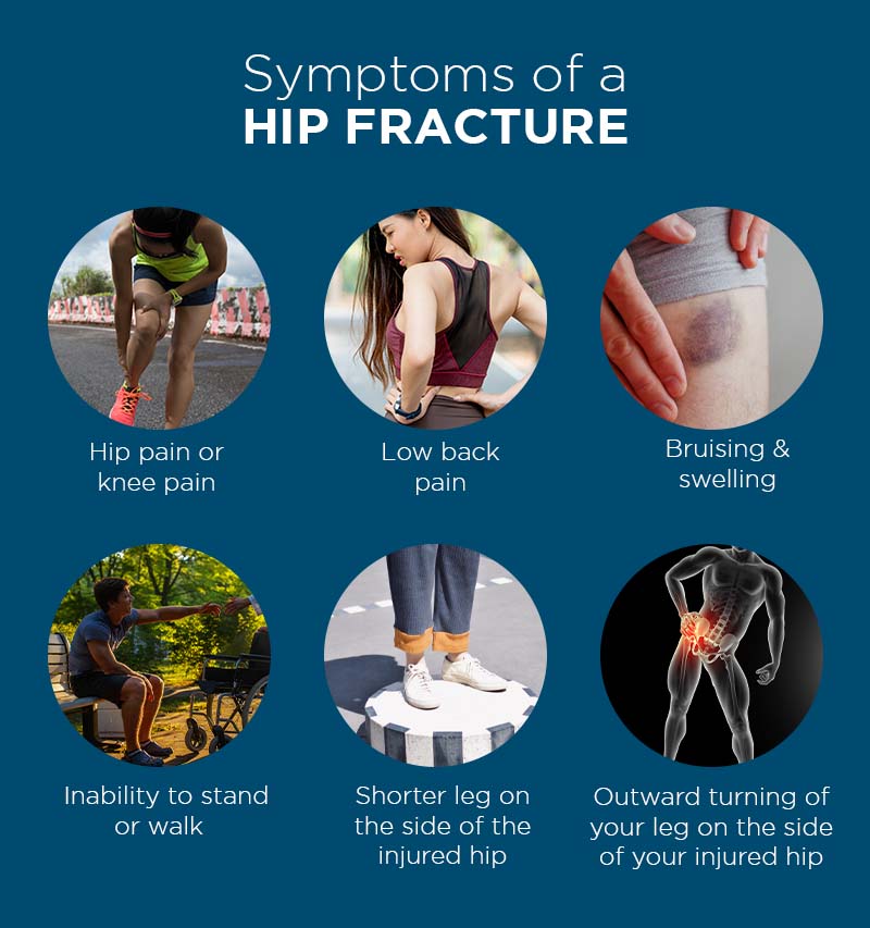 Hip Fracture Symptoms: What to Spot & Why They Matter Now