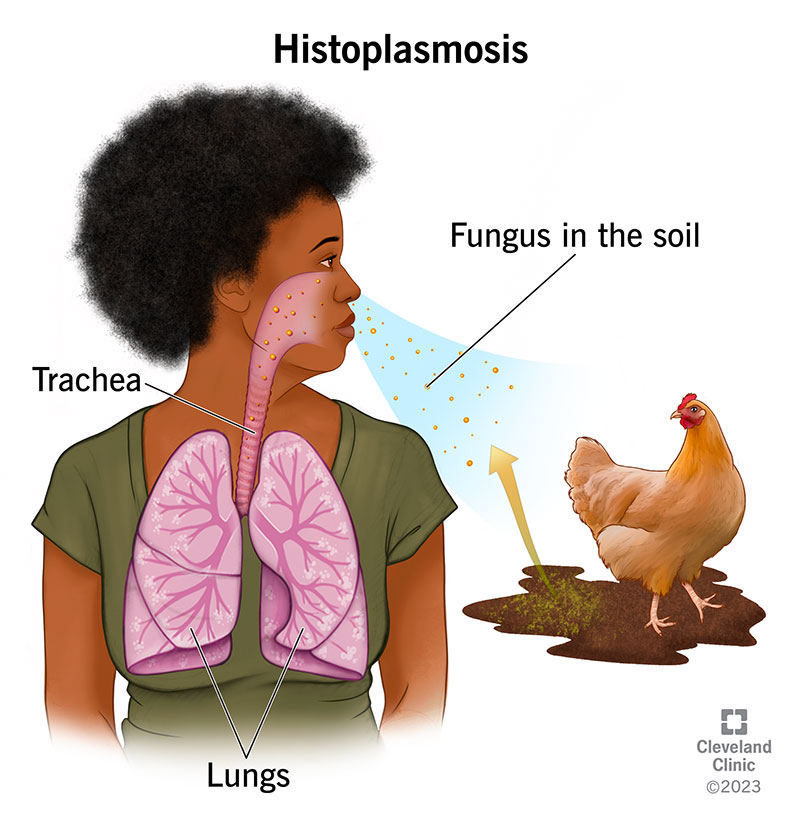 Histoplasmosis Lung Infection: Symptoms, Treatment & Hope