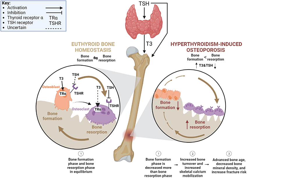 How Hyperthyroidism Impacts Bone Density and What to Do