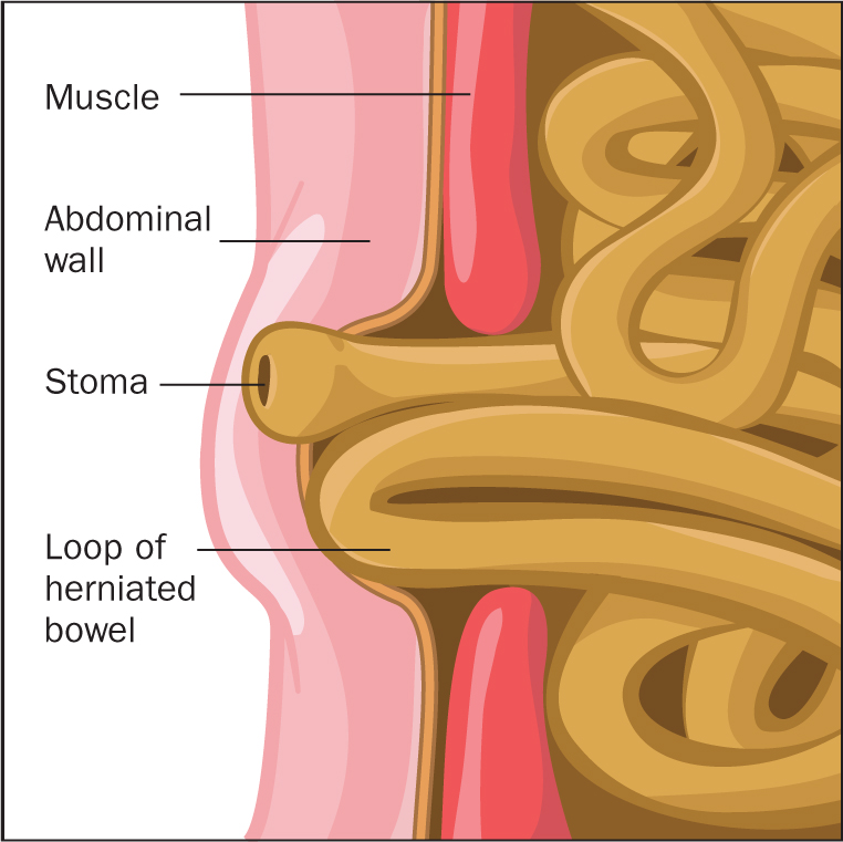 Ileostomy Hernia: Causes, Symptoms & Treatment