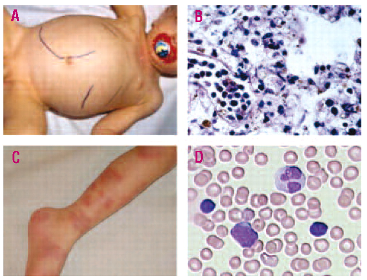 Juvenile Leukemia: Hope, Facts & Guidance for Families