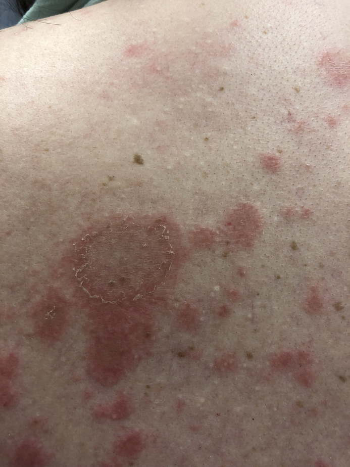Lupus Rash vs Hickey – How to Tell the Difference
