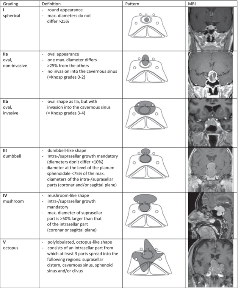 Macroadenoma Size Criteria: When Tumor Becomes ‘Macro’