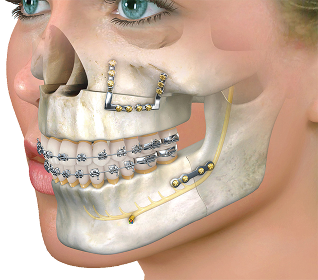 Maxillofacial Surgery: What It Is, Procedures & What to Expect