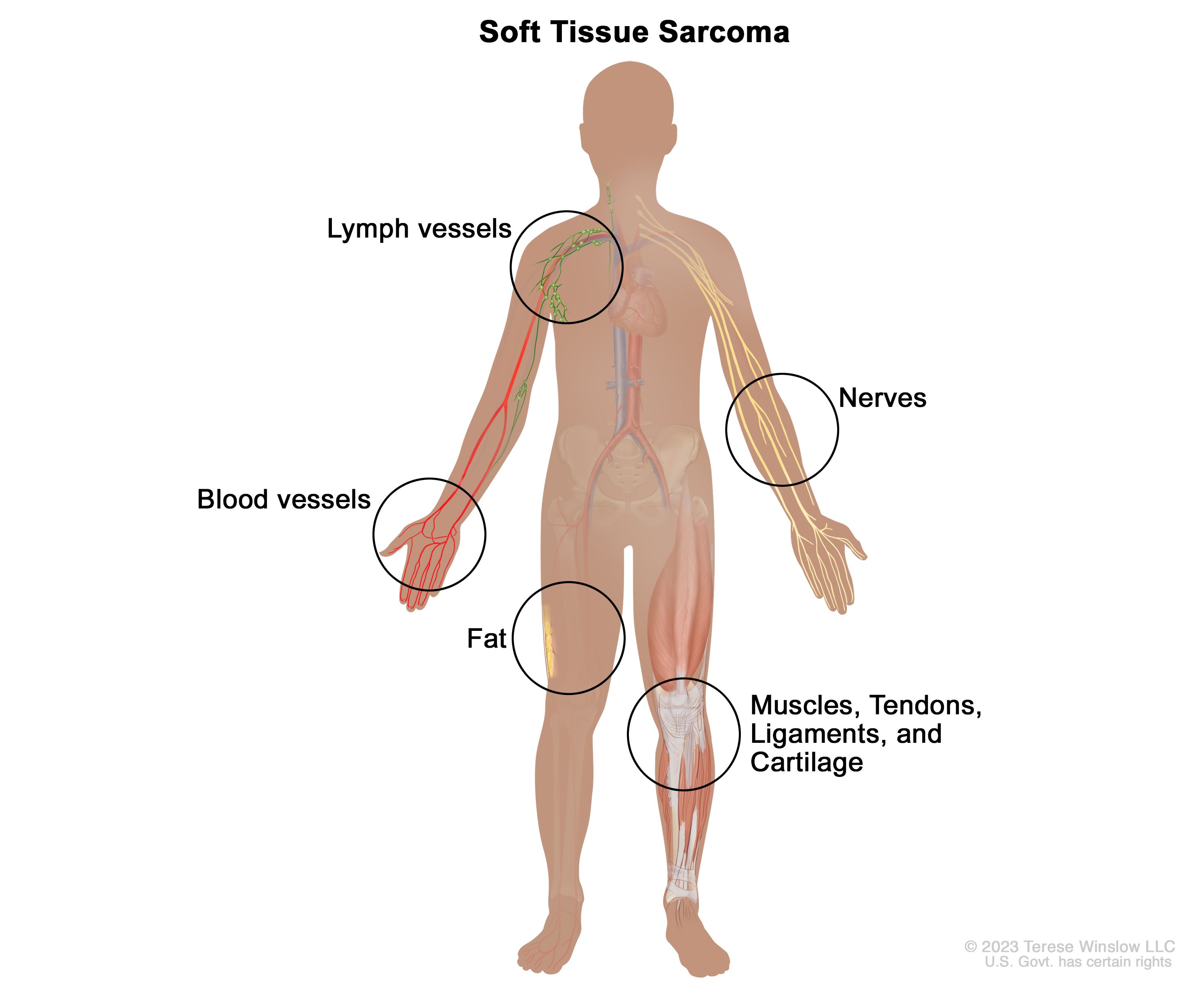 Metastatic Soft Tissue Sarcoma: Diagnosis, Treatment & Outlook