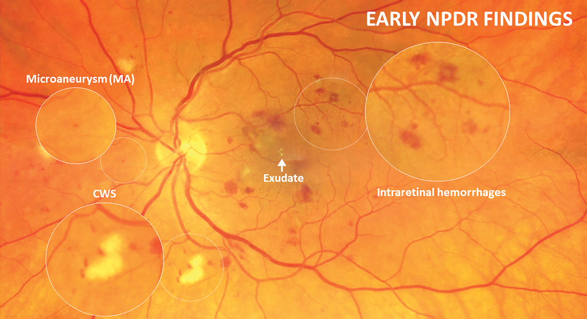 Microaneurysms Diabetic Retinopathy: Essential Guide