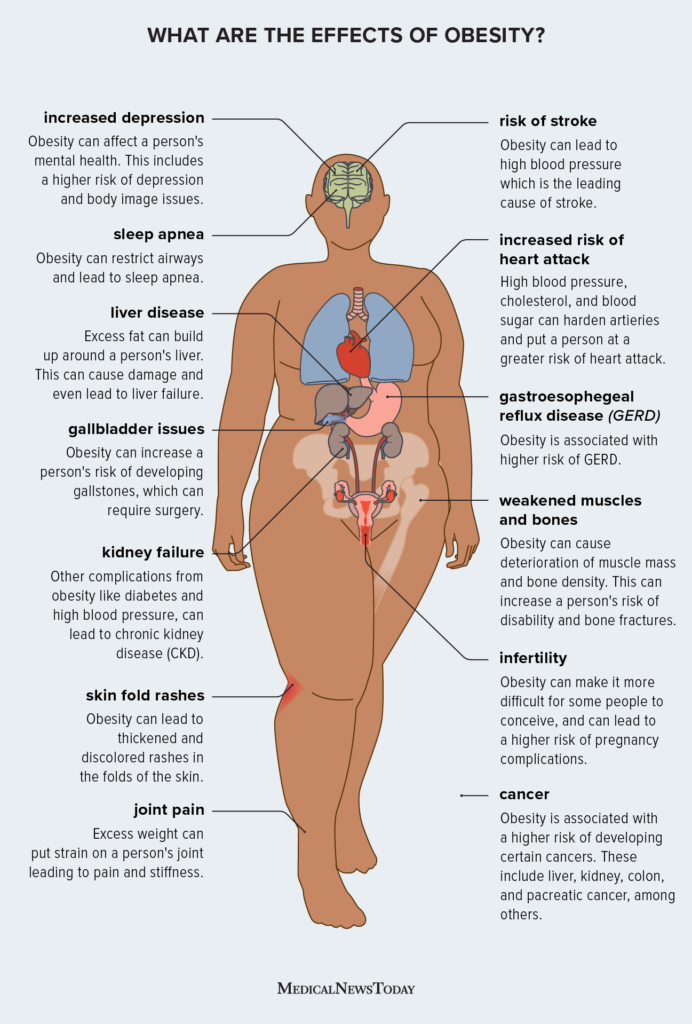 Obesity Risk Explained: Causes, Symptoms & Solutions