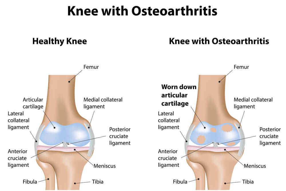 Osteoporosis Joints: What You Need to Know Now