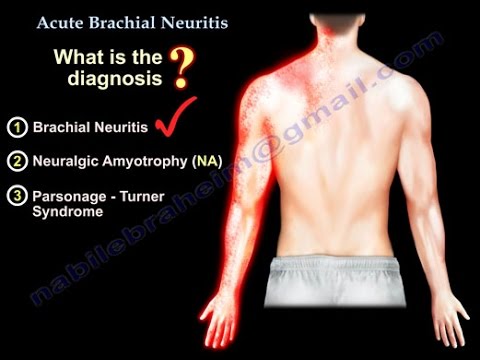 Parsonage‑Turner Symptoms: What You Need to Know