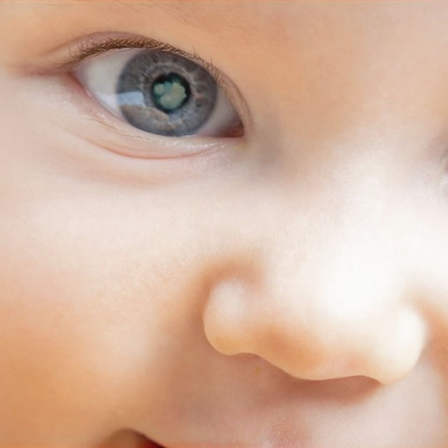 Pediatric Cataract: What Every Parent Must Know Today