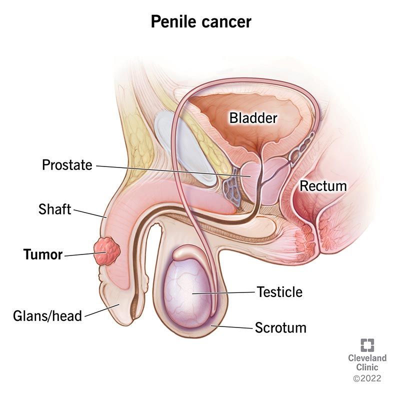 Penile Cancer Treatment: Options, Risks & Expectation