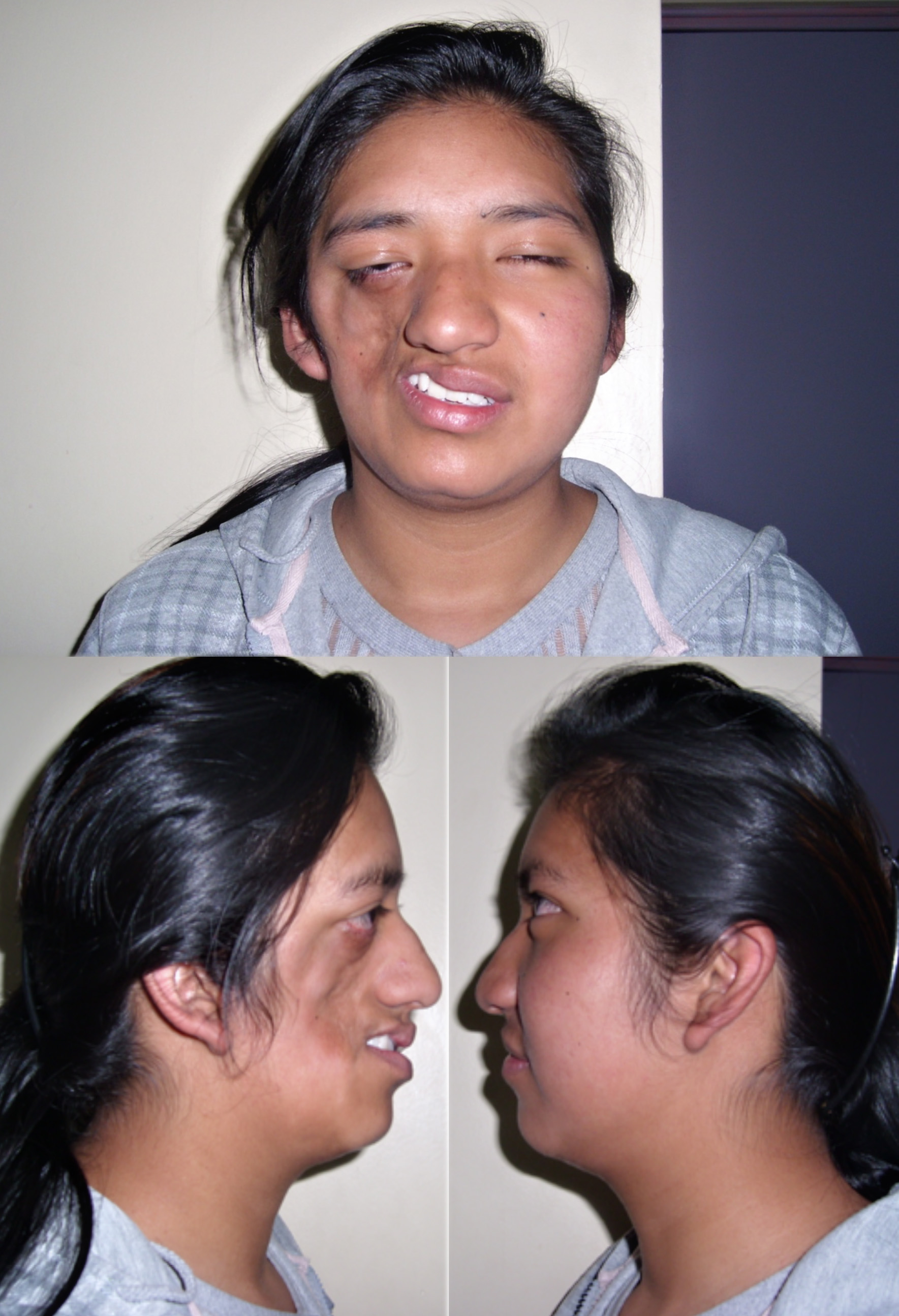 Progressive hemifacial atrophy – causes, symptoms & treatment