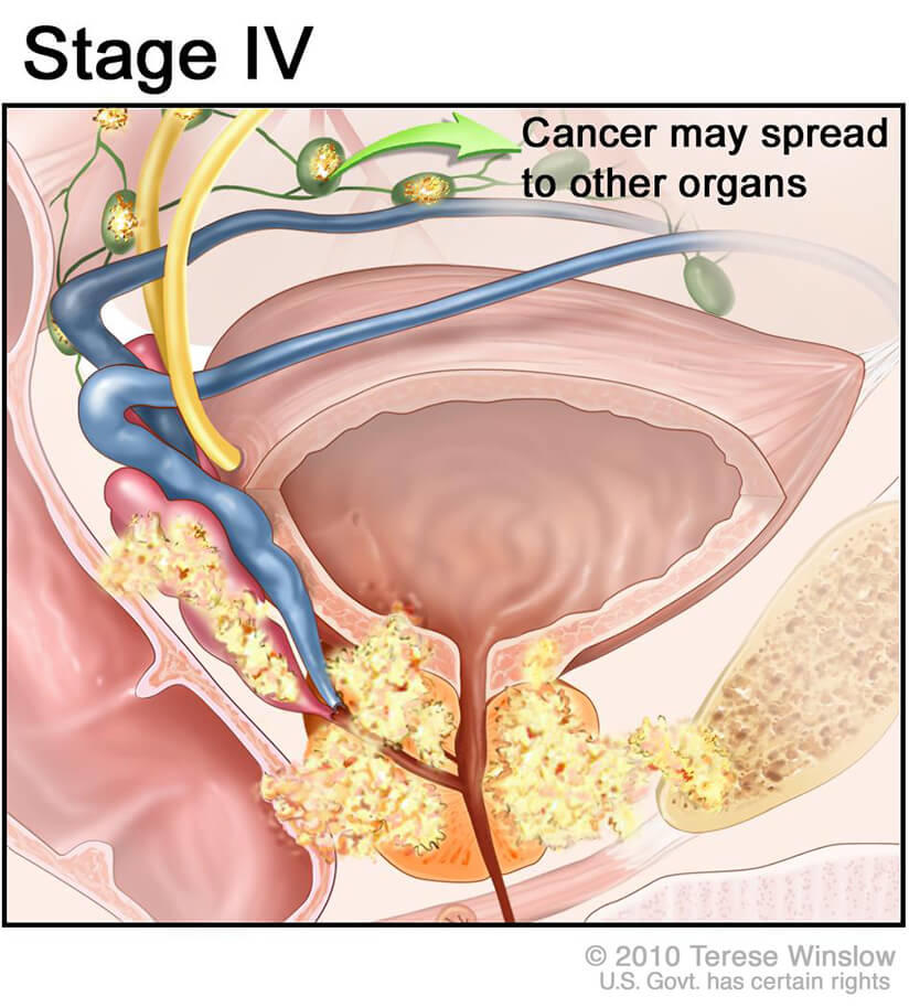 Prostate Cancer Stage 4 – What You Need to Know Now