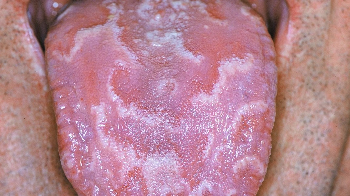 Psoriasis Oral Health: Key Ways to Protect Your Smile