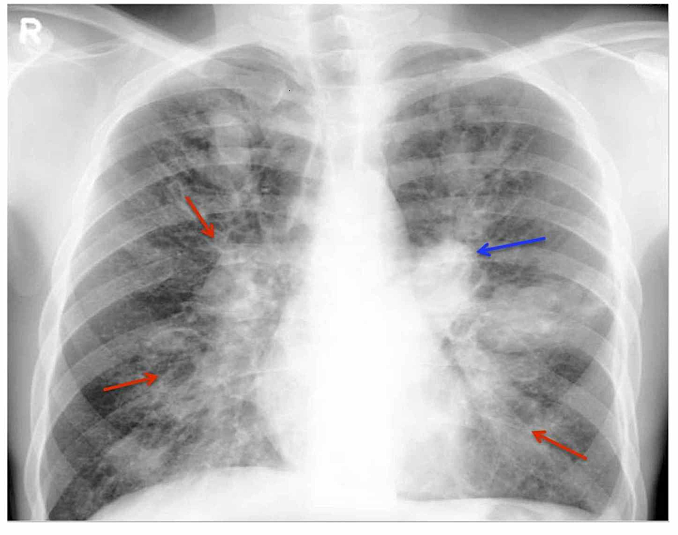 Pulmonary Aspergillosis: Symptoms, Diagnosis & Treatment