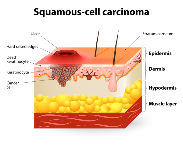 Squamous Cell Neck: Symptoms, Stages & What to Expect