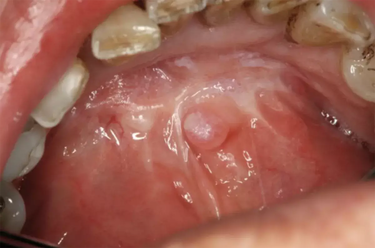 Stage 4 Mouth Cancer: Symptoms, Treatment & Outlook