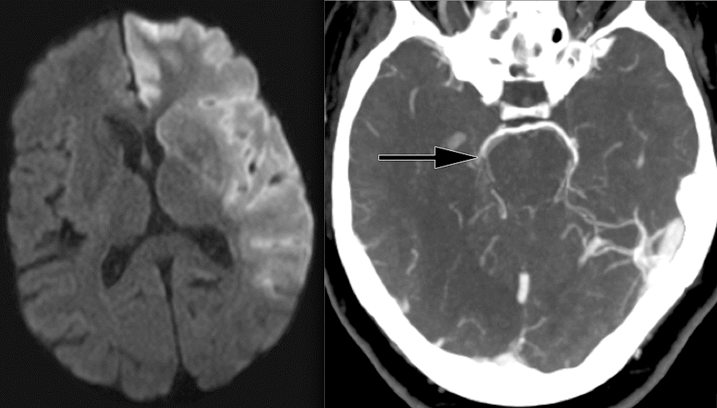 Stroke Detection CT: Quick Answers & Life‑Saving Facts
