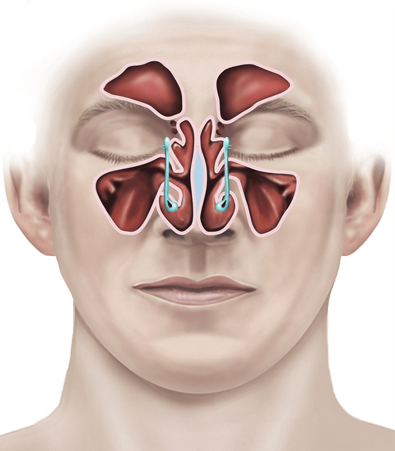 Surgery with Hay Fever: What You Need to Know