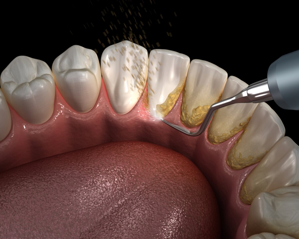 Teeth Cleaning: Why It Matters & How It Boosts Smile
