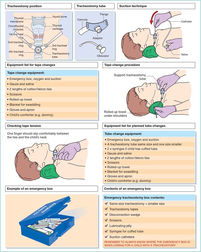 Trach Cleaning Guide: Simple Steps for Safe Home Care
