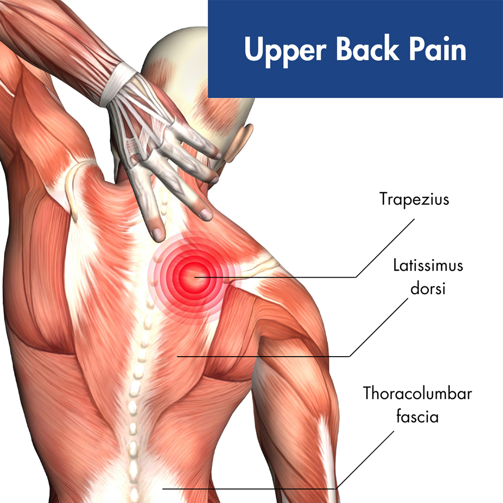 Upper Back Nerve Pain – What’s Really Going On?