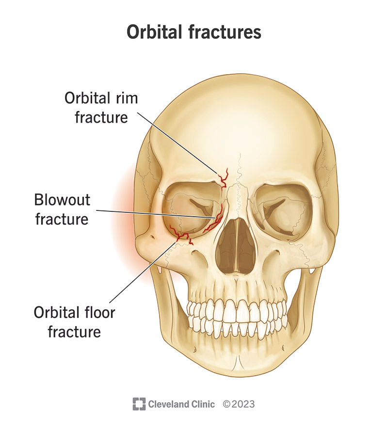 Orbital Fracture Symptoms: What to Watch For Now