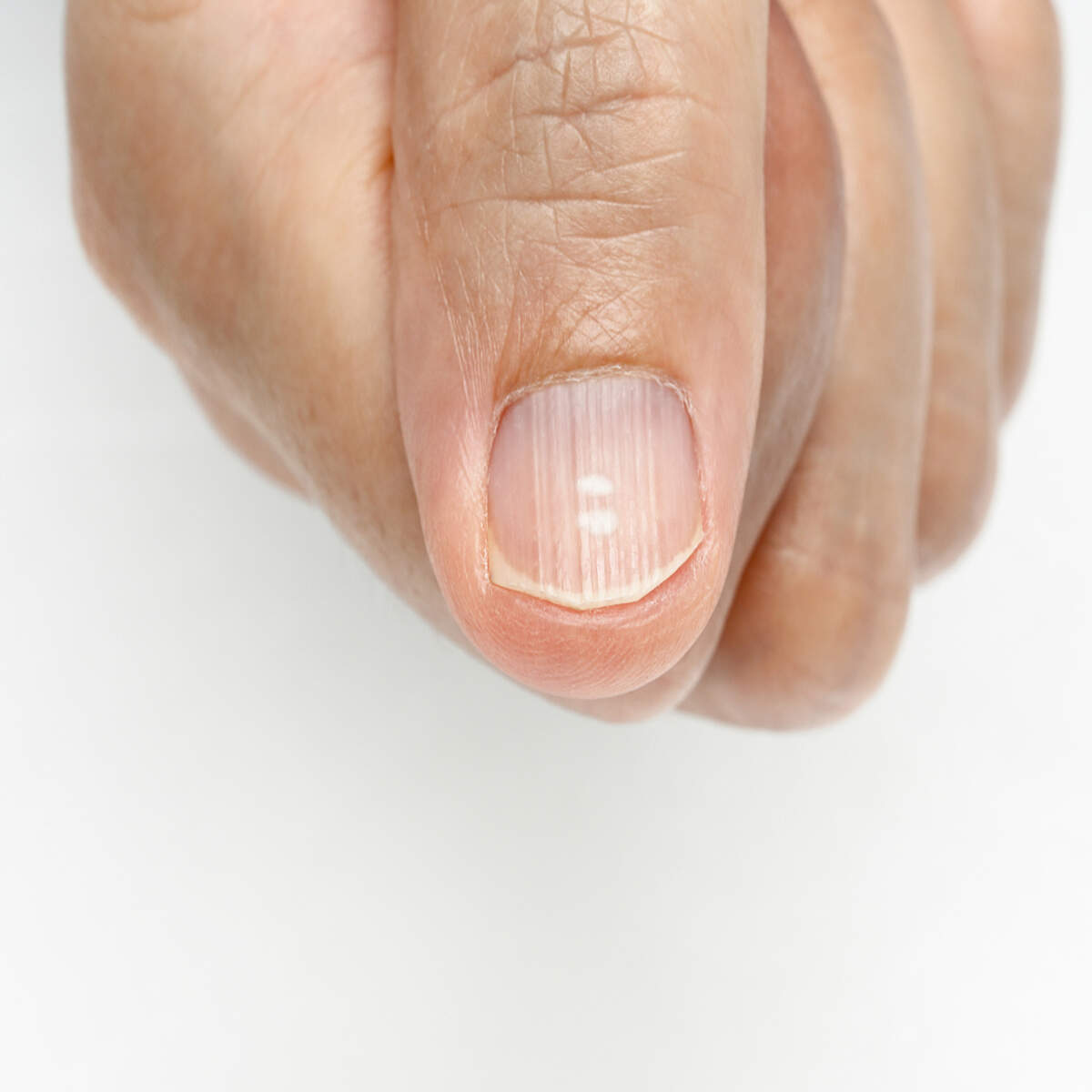Anemia Nails: Signs, Causes & Simple Treatments