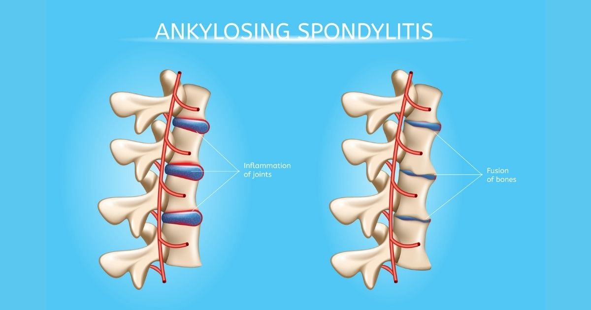 Ankylosing Spondylitis Chiropractic: Safe Relief Guide
