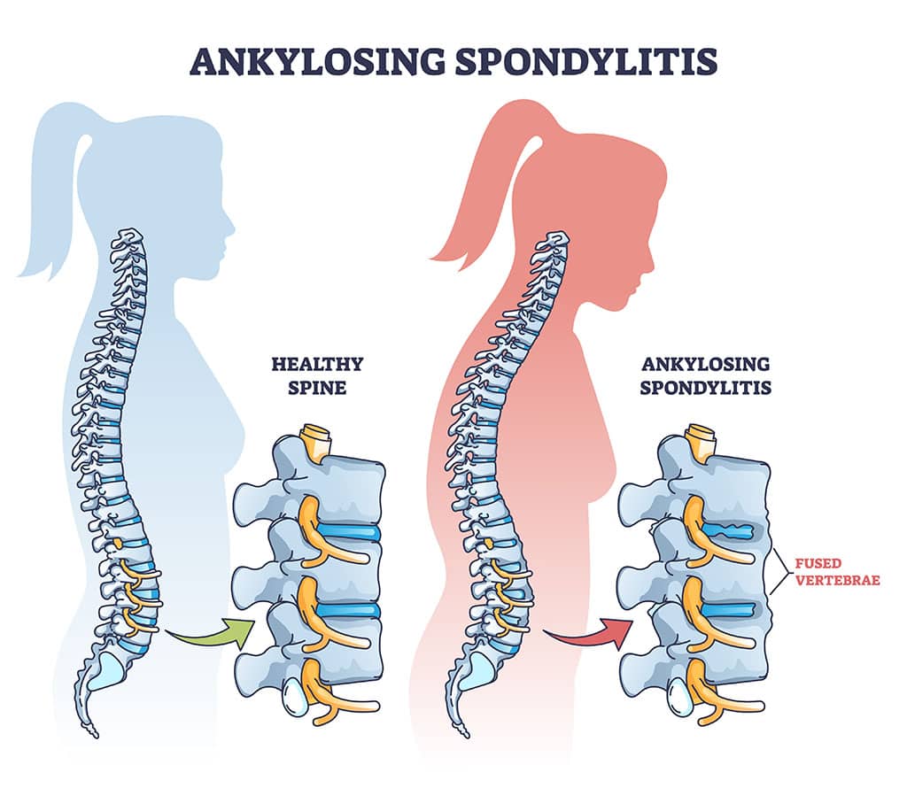 Ankylosing Spondylitis Life Expectancy: Key Facts