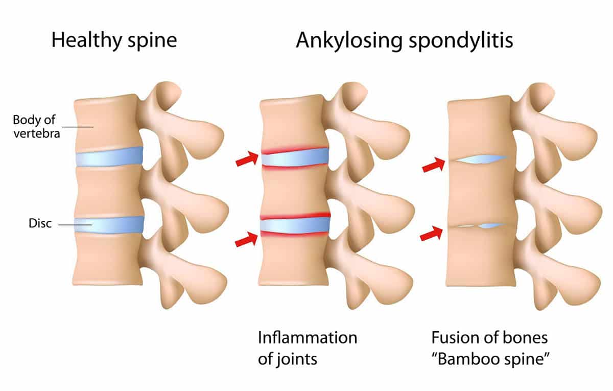 Ankylosing Spondylitis Progression: Essential Guide