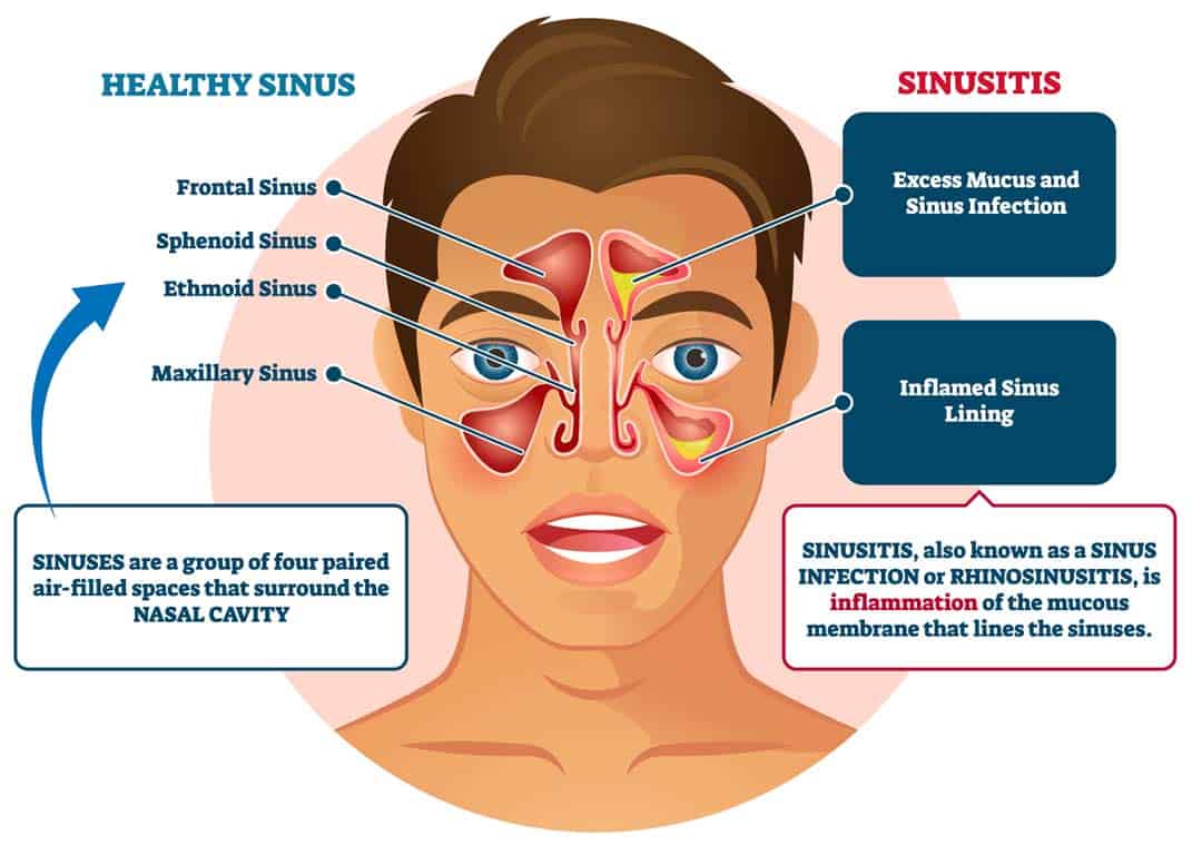 Asthma Sinusitis Symptoms: What to Watch For