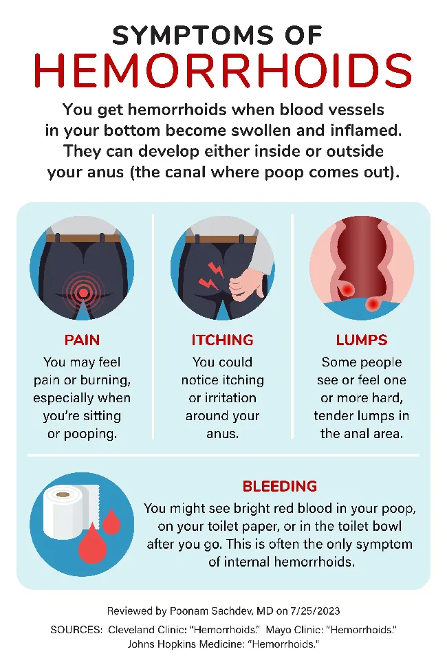 Causes of Itchy Hemorrhoids and Simple Ways to Relieve