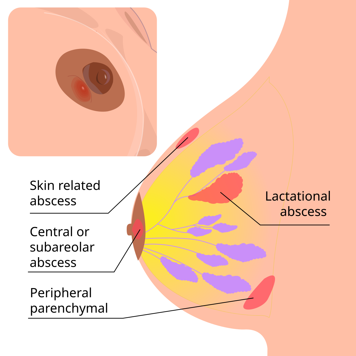 Chest Abscess: Symptoms, Causes & Treatment Guide