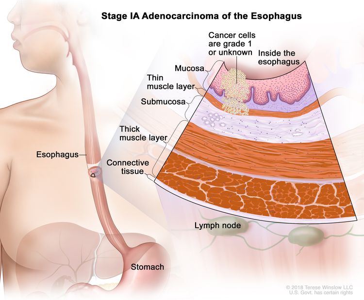 Esophageal Radiation Types: What to Expect and Benefits