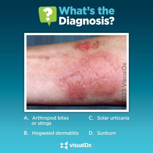 Hogweed Dermatitis – Symptoms, Treatment & What to Expect