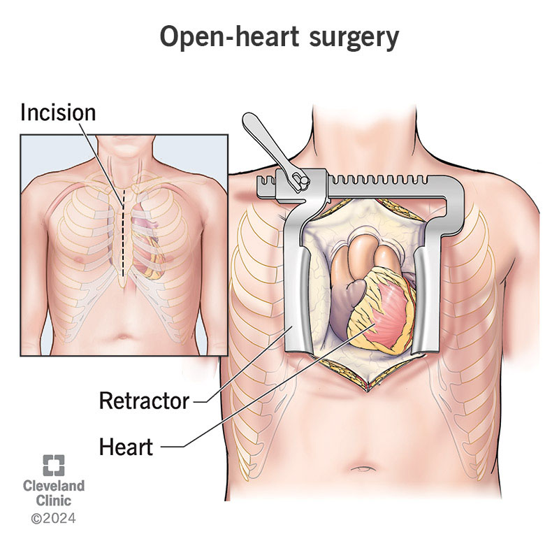 How Long Does Open Heart Surgery Qualify for Disability?