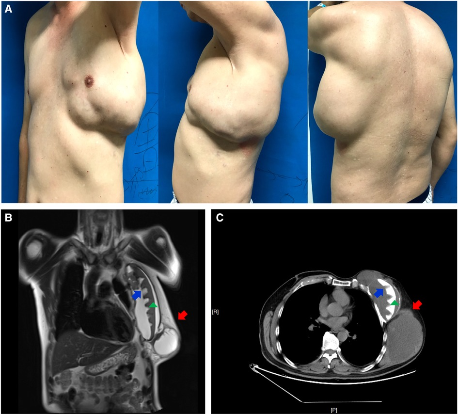 Implant Associated Cancers: What You Need to Know