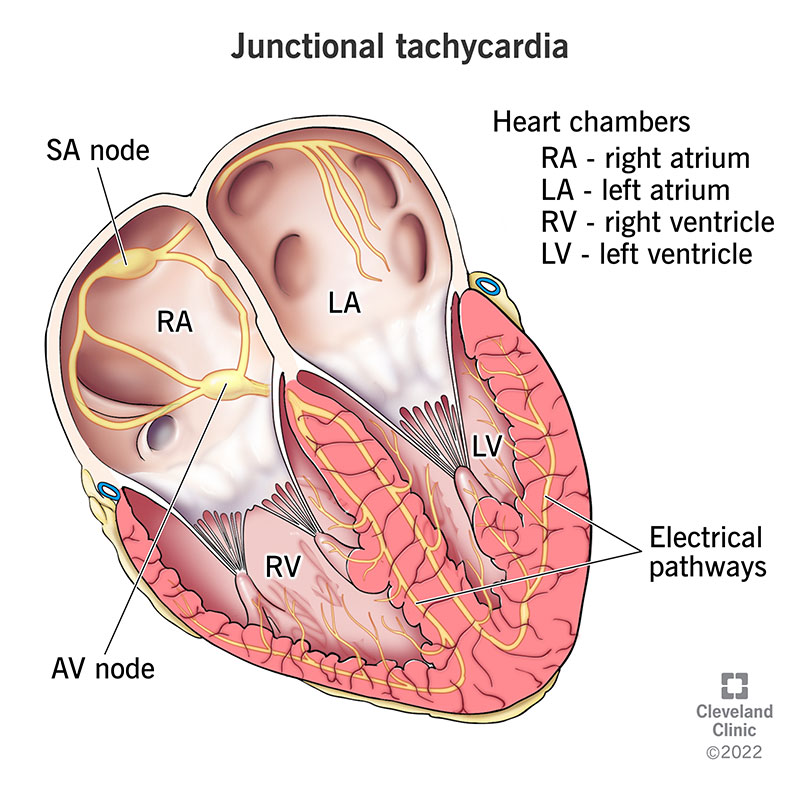 Junctional Rhythm Symptoms: What They Mean and Risks