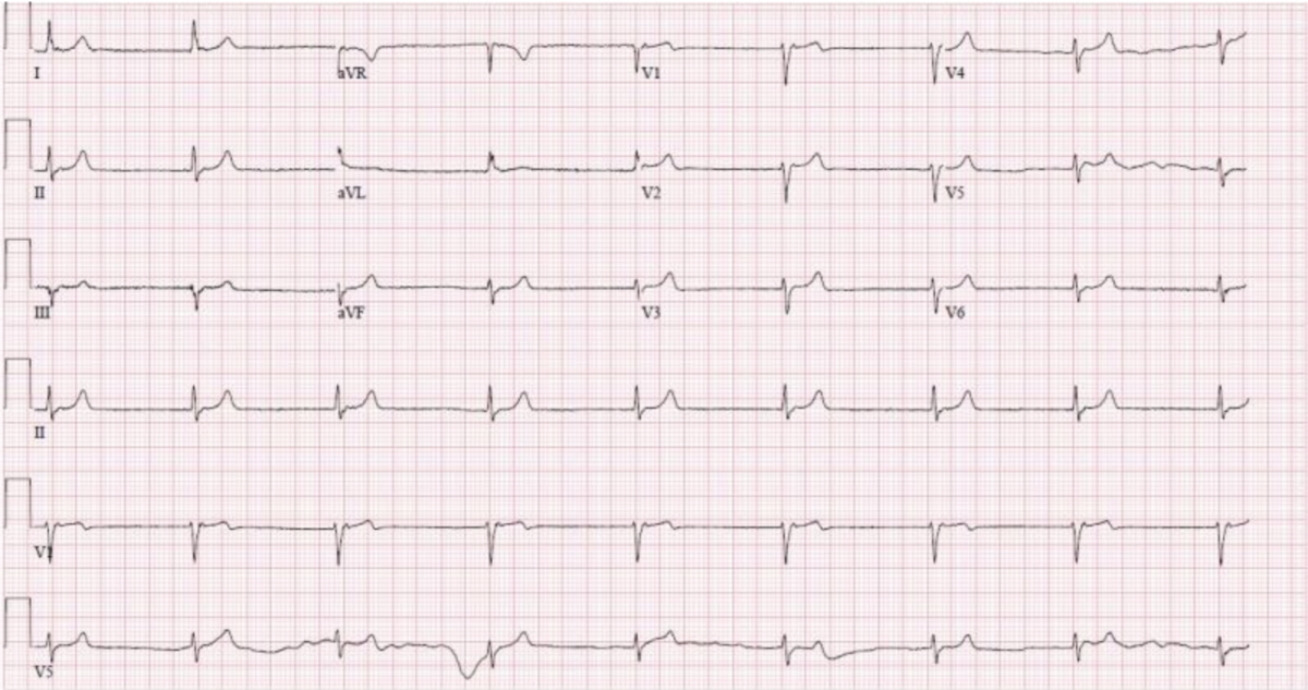 Understanding Junctional Rhythm: Causes, ECG & Treatment
