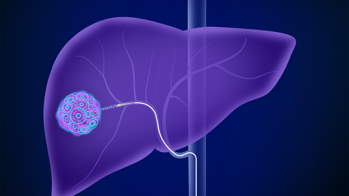 Liver Cancer Radiation: What You Need to Know Today