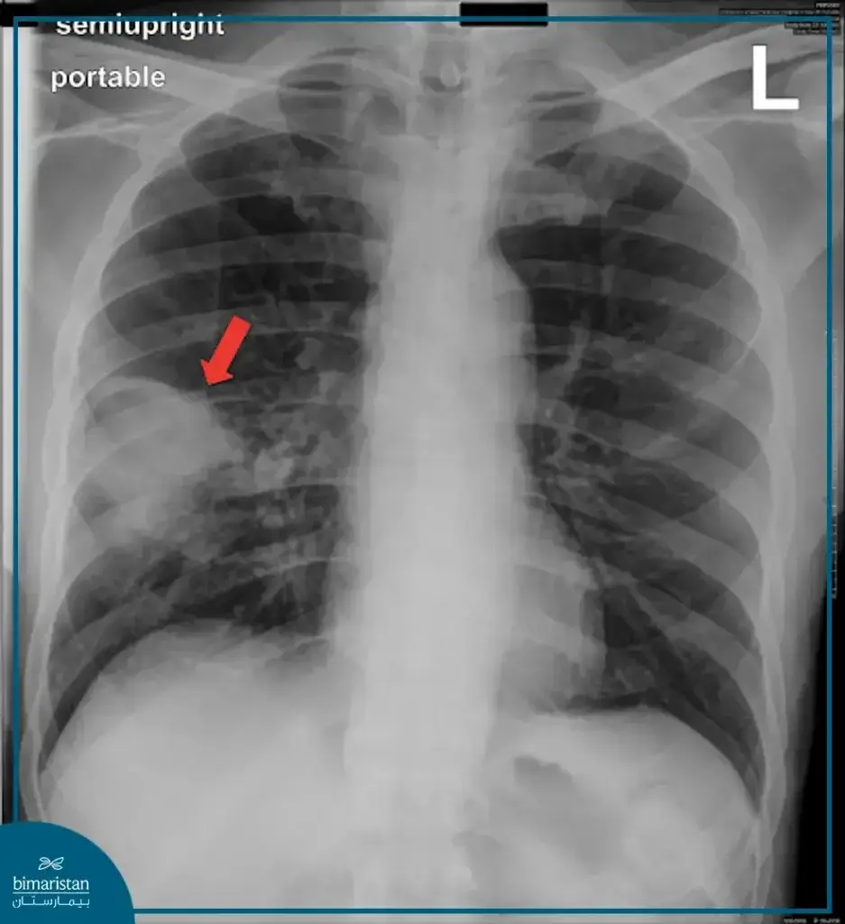 Lung Abscess: Causes, Symptoms, Diagnosis & Treatment