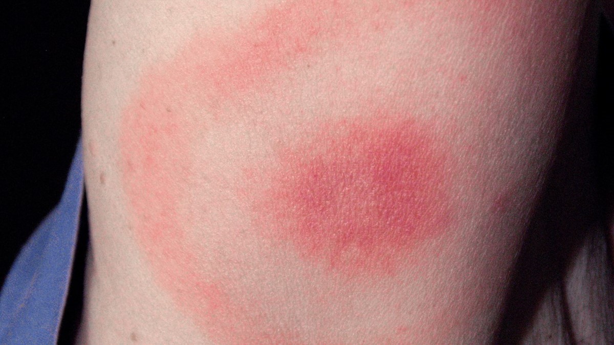 Lyme Disease Tick Bite: Symptoms, Risks & What to Do