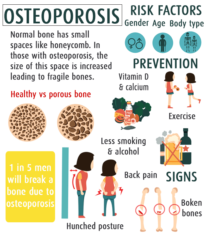 Osteoporosis Men: Risks, Symptoms & Treatment