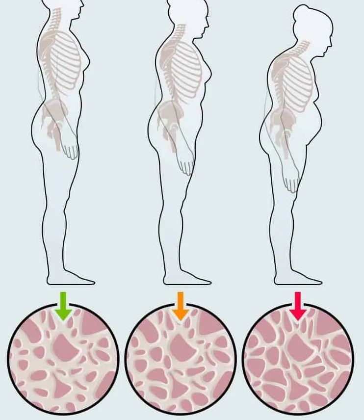 Osteoporosis Women: Signs, Risks & Simple Care Tips