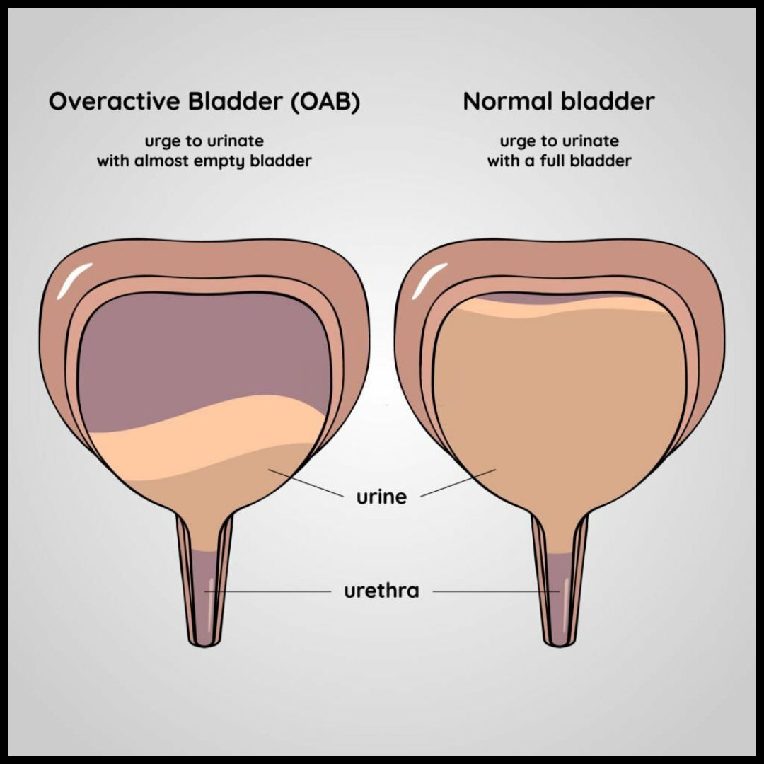 Overactive Bladder SSI: What You Need to Know